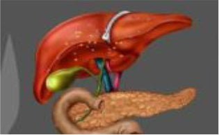 gallbladder-stones-surgery