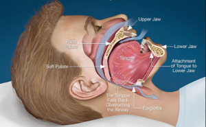 Read more about the article HOW OBESITY CAUSES SLEEP APNEA?